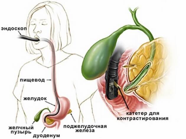 Что такое эндоскопия поджелудочной железы и как она делается