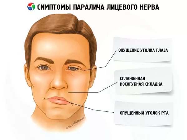 Невропатия лицевого нерва