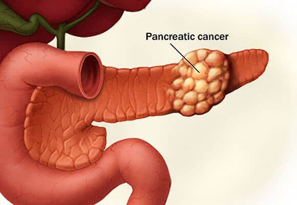 Панкреатит поджелудочной железы