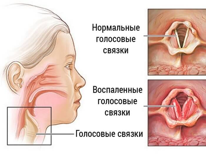Рак горла (опухоли гортани)